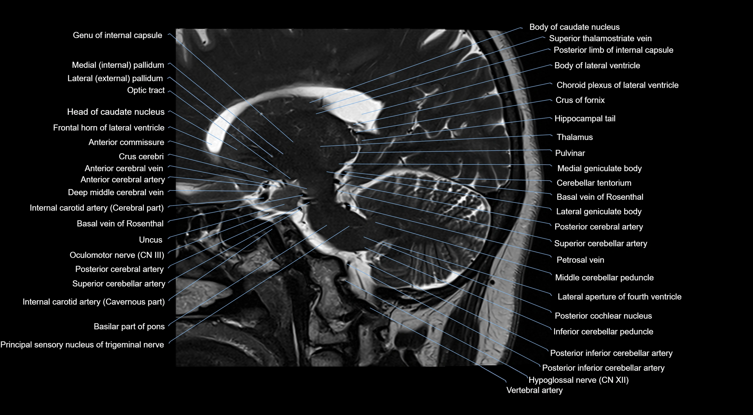 MRI brainstem & basal ganglia anatomy labelled  3T MRI images -img-10001-00018.webp